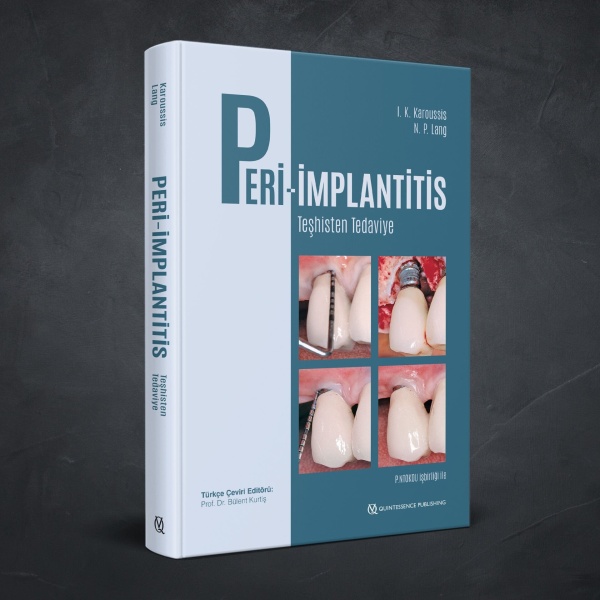 PERI-IMPLANTITIS-Teshisten-Tedaviye